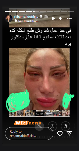 صور مرعبة للإعلامية ريهام سعيد بسبب فشل عمليات التجميل